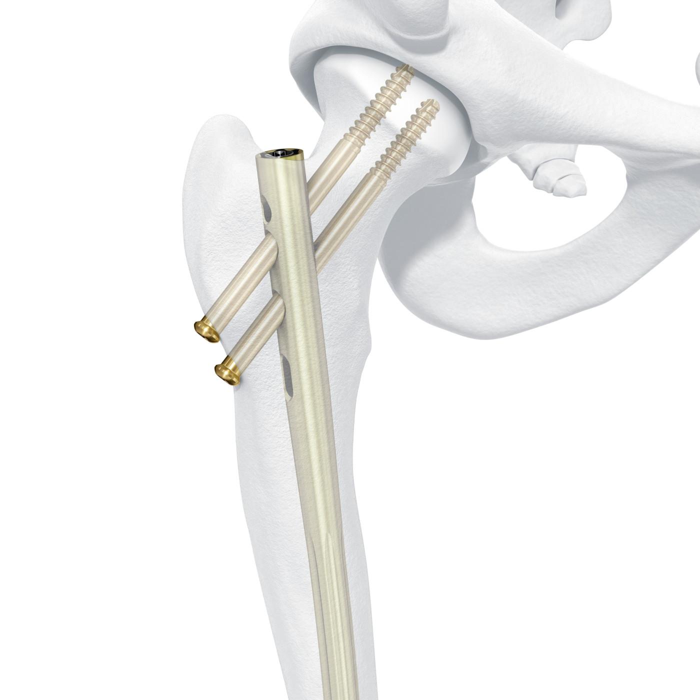 Femoral Recon Nail
