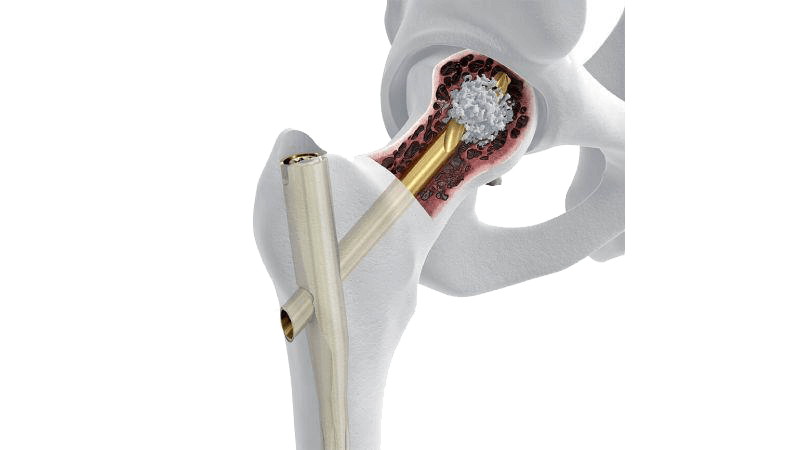 TFN-ADVANCED System seen inside of hip