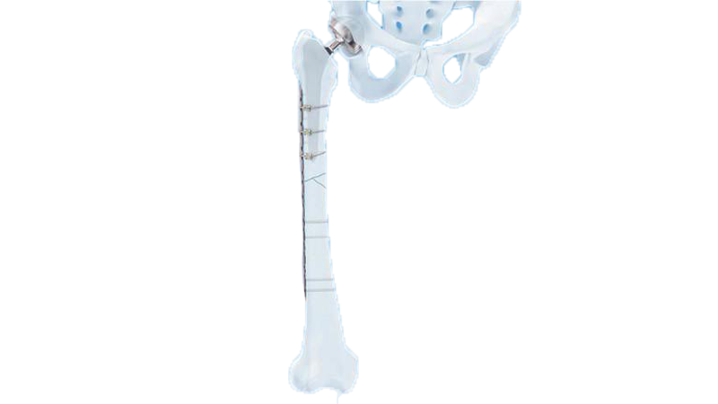 The LCP Periprosthetic System shown in place in the hip and femur bone