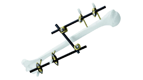 Medium External Fixator attached to bone