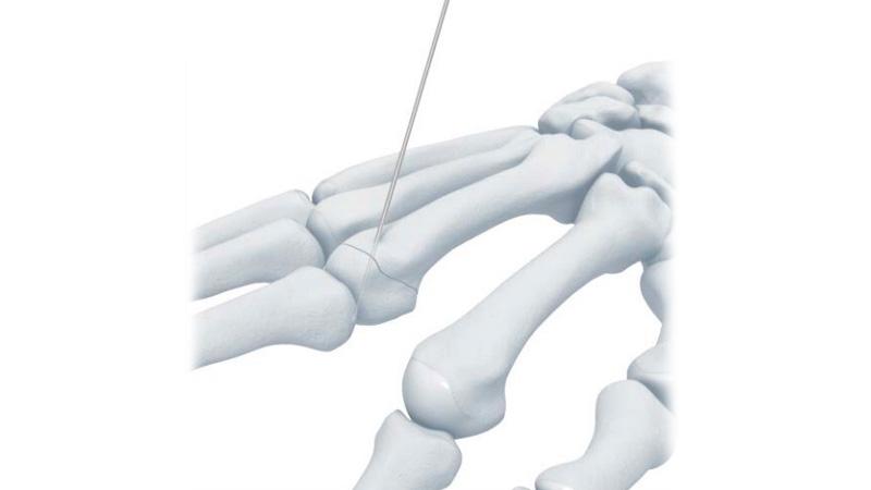 hand fracture repair using Kirschner wire