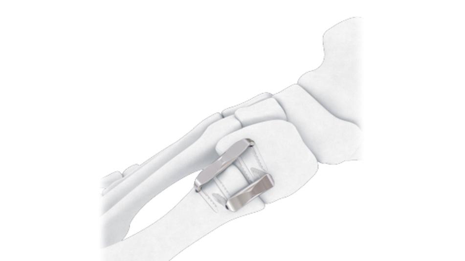BME ELITE Implant fully inserted foot bones for hallux valgus deformity correction.