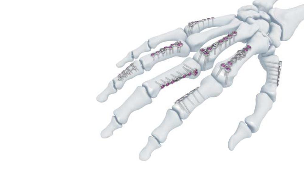 bones of the hand with VA locking hand implants installed