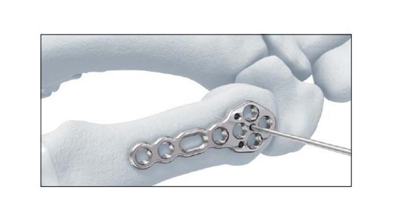 Variable Angle Locking Hand System First Metacarpal Plate Dorsal Placement on hand