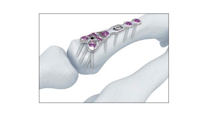 Variable Angle Locking Hand System Metacarpal Neck Plate screw placement is seen in the hand