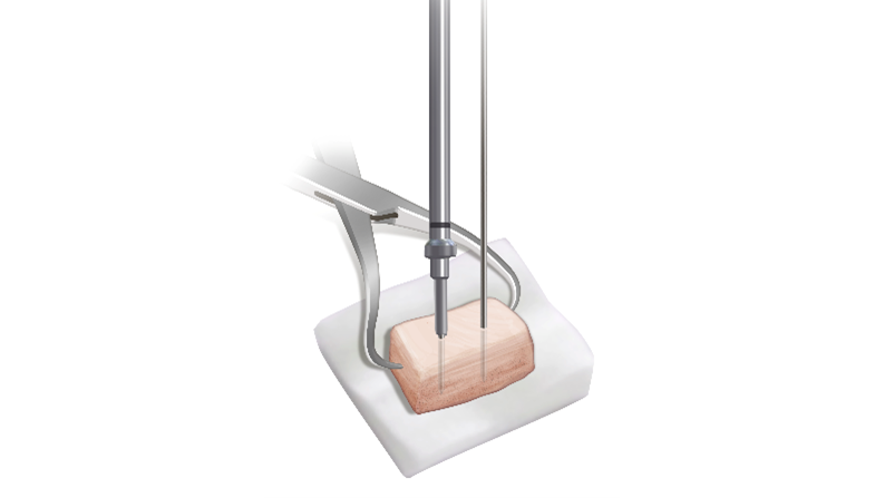 Distal Tibial Allograft (DTA) Preparation 3