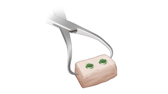Distal Tibial Allograft (DTA) Preparation 4