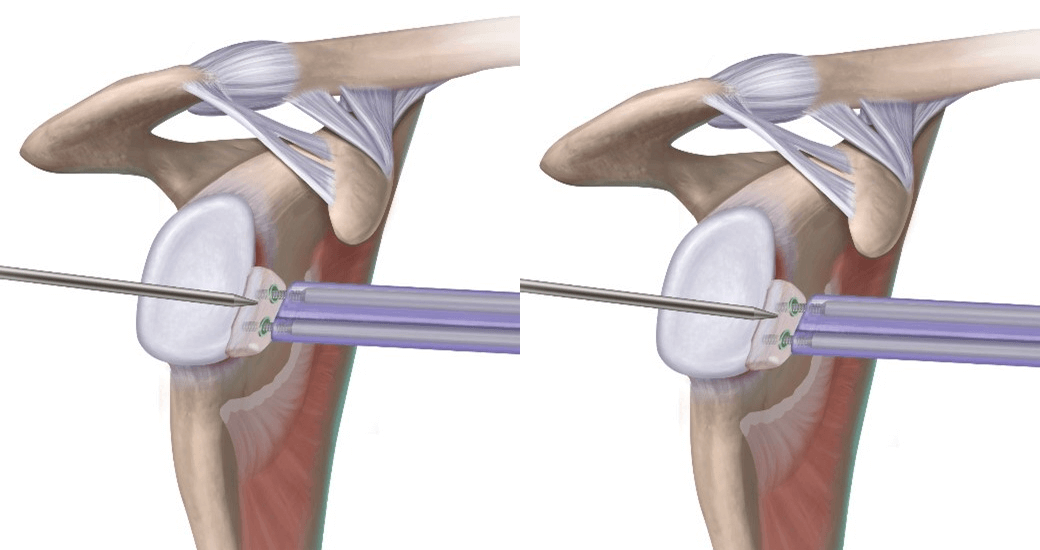 Graft Positioning