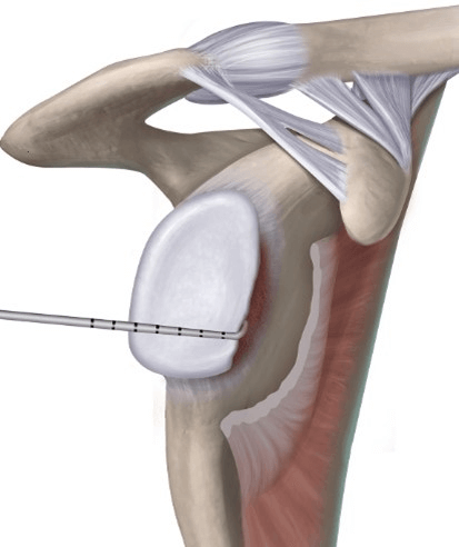 Determine the Glenoid Bone Loss