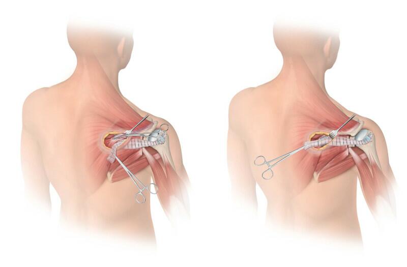 Lower Trapezius-Allograft Attachment 3