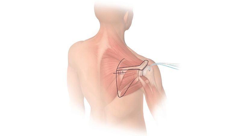 Diagnostic Arthroscopy