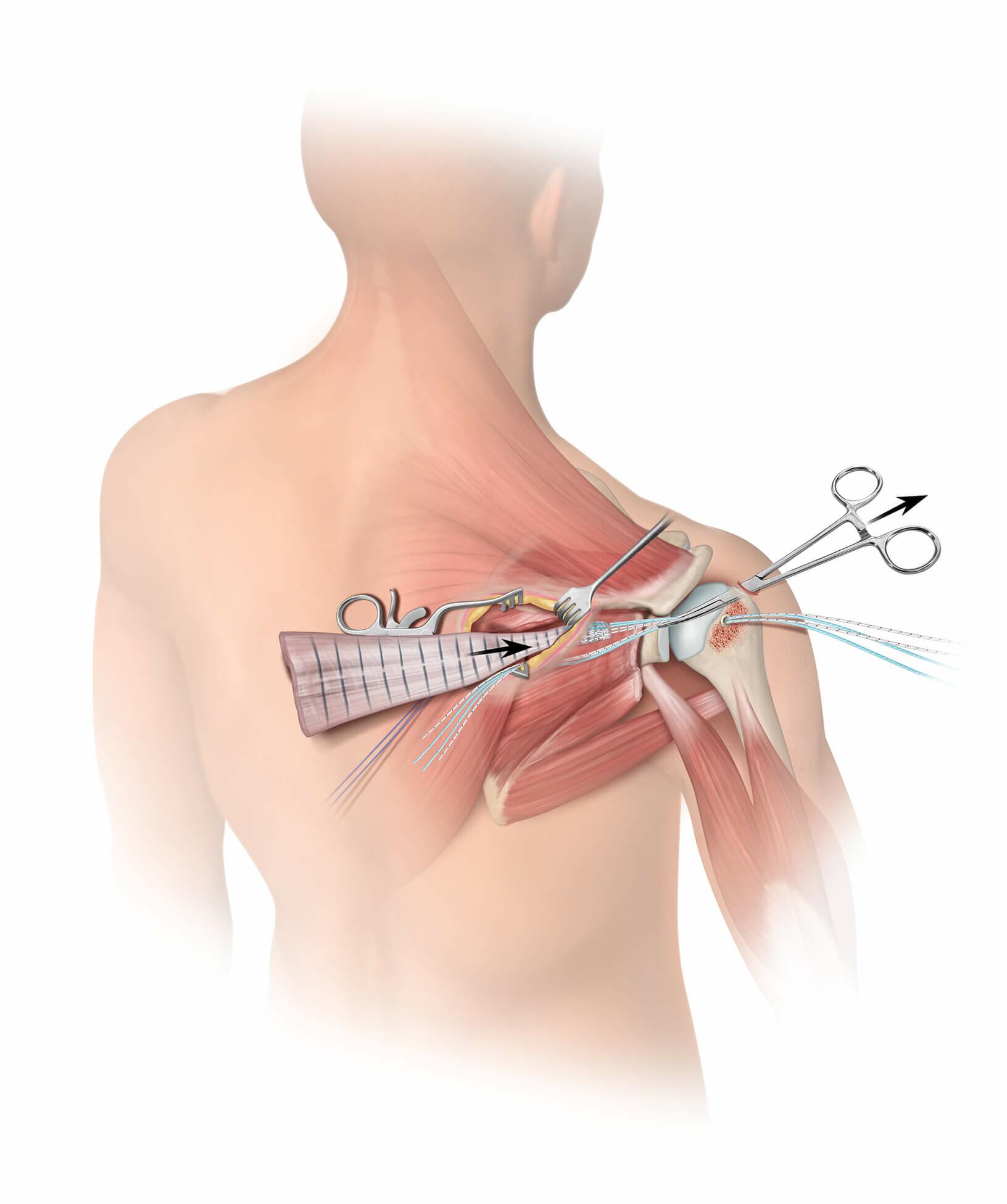 Arthroscopic Allograft Passage
