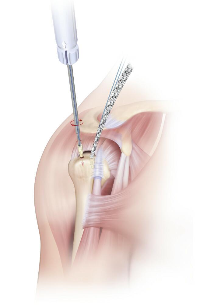 Two HEALIX ADVANCE™ Anchors with DYNATAPE™ Sutures inserted into the articular margin