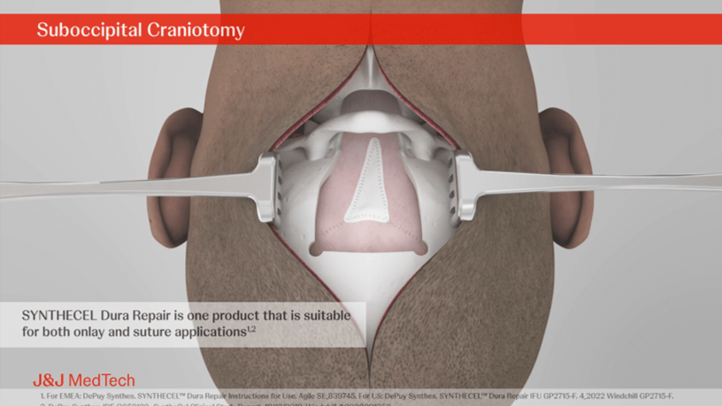 Suboccipital Craniotomy