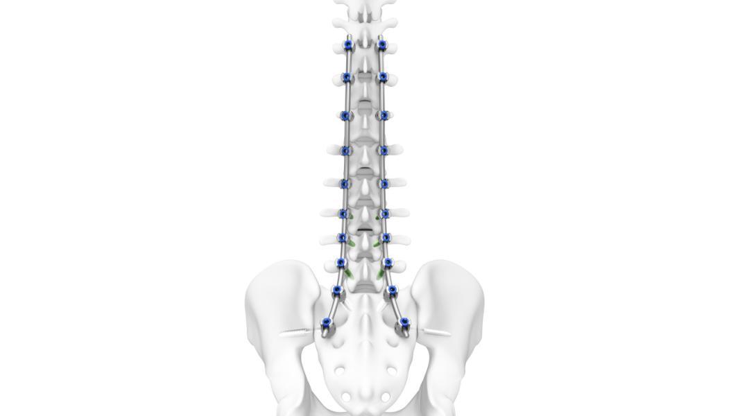 Illustrated example of TriALTIS™ Spine System attached to a human spine.