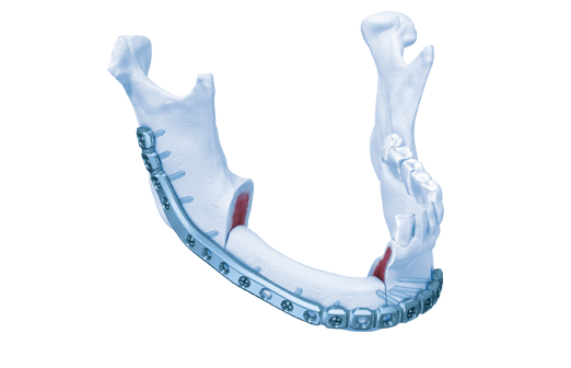 MatrixMANDIBLE™ System