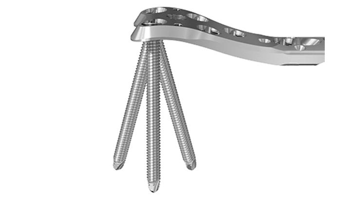 Variable Angle Curved Condylar Plate shown in side view with screws